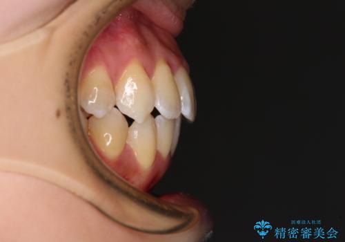 【モニター】急速拡大装置 狭い歯列を拡大してワイヤー装置で短期間治療の治療後