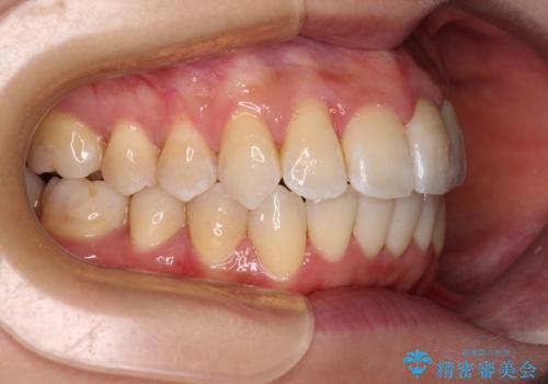 【モニター】急速拡大装置 狭い歯列を拡大してワイヤー装置で短期間治療の治療後