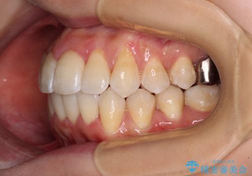 【モニター】急速拡大装置 狭い歯列を拡大してワイヤー装置で短期間治療の治療後