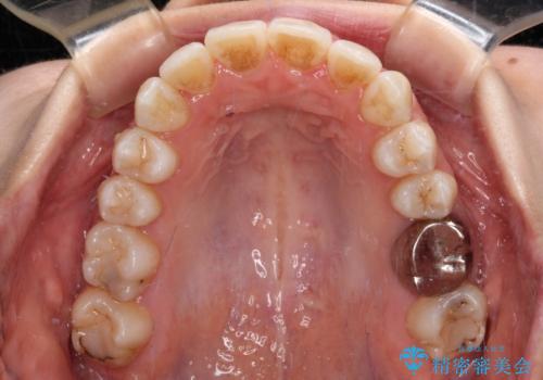 【モニター】急速拡大装置 狭い歯列を拡大してワイヤー装置で短期間治療の治療後