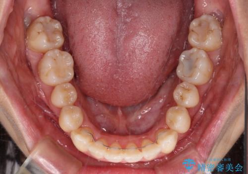 【モニター】急速拡大装置 狭い歯列を拡大してワイヤー装置で短期間治療の治療後