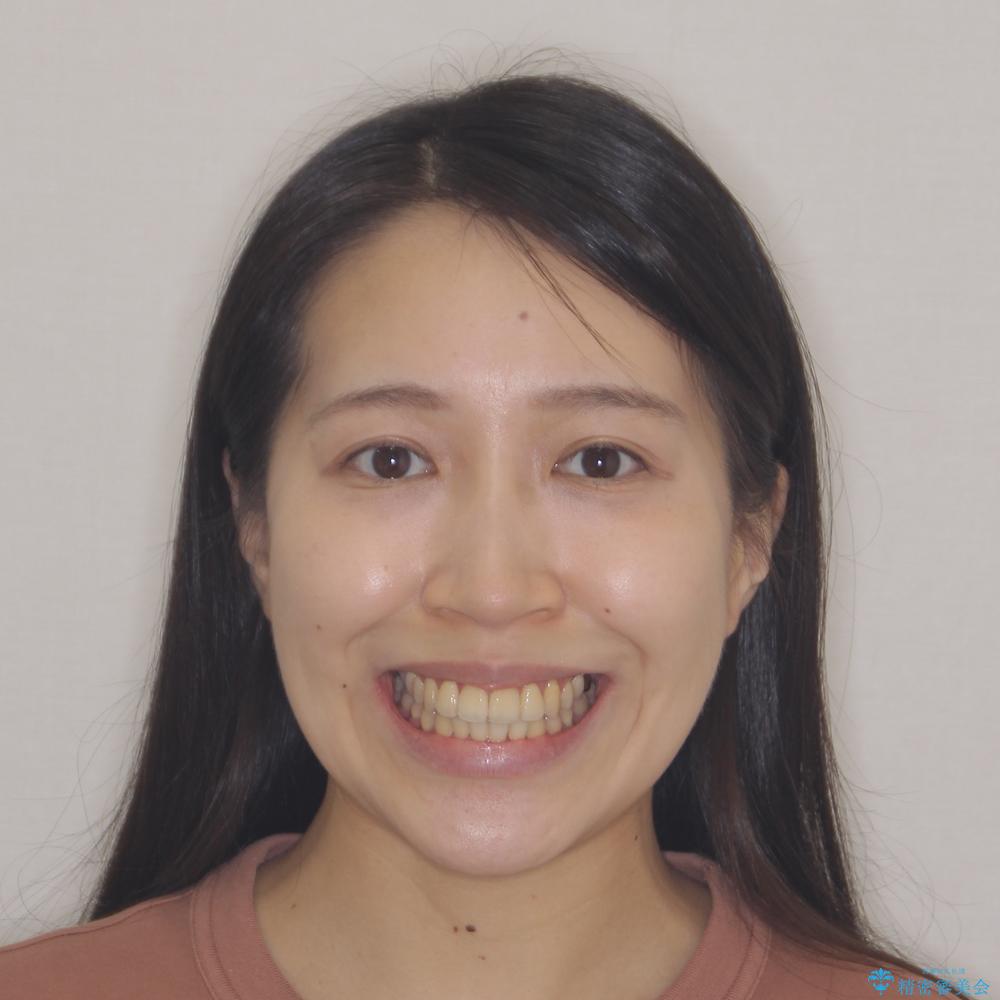 【モニター】急速拡大装置 狭い歯列を拡大してワイヤー装置で短期間治療の治療後(顔貌)