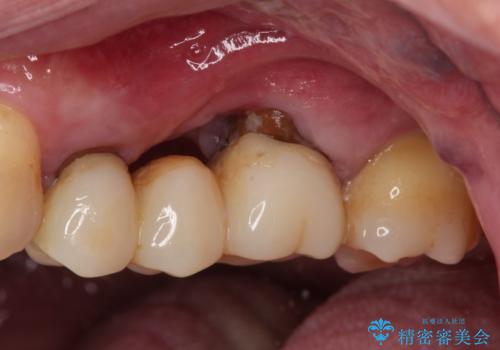 ものが挟まって痛む 割れてしまった歯のオールセラミックブリッジ治療の治療中