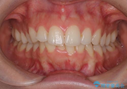 【インビザライン】前歯のガタガタをなおしたい。の治療前