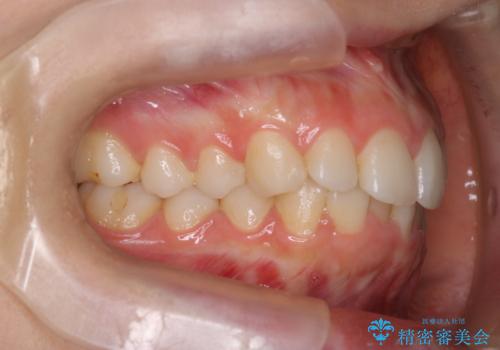 【インビザライン】前歯のガタガタをなおしたい。の治療前