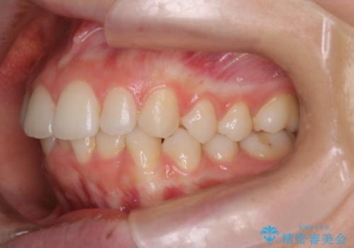 【インビザライン】前歯のガタガタをなおしたい。の治療前