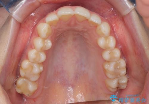 【インビザライン】前歯のガタガタをなおしたい。の治療前