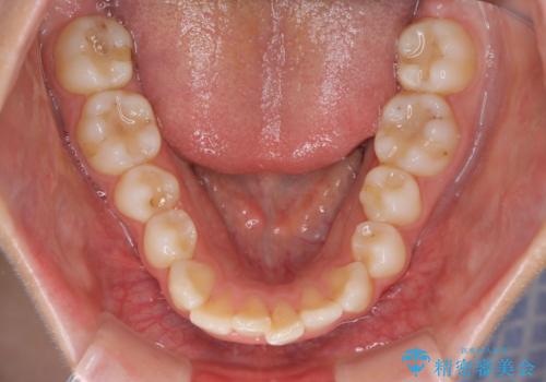 【インビザライン】前歯のガタガタをなおしたい。の治療前