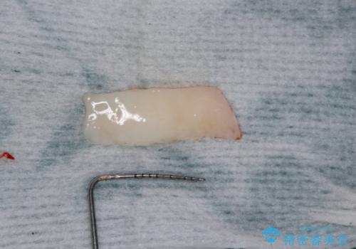 ものが挟まって痛む 割れてしまった歯のオールセラミックブリッジ治療の治療中