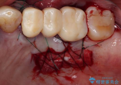 ものが挟まって痛む 割れてしまった歯のオールセラミックブリッジ治療の治療後