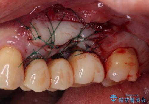 ものが挟まって痛む 割れてしまった歯のオールセラミックブリッジ治療の治療前
