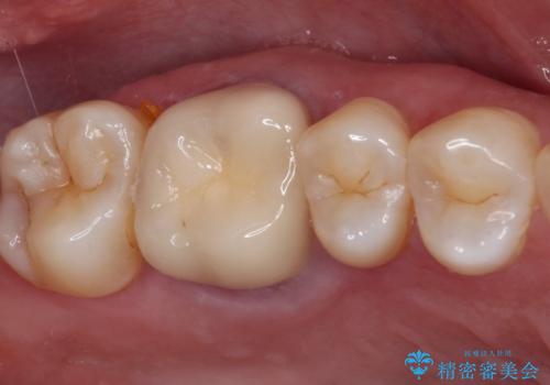 指摘された虫歯 オールセラミッククラウンによる補綴治療の治療前