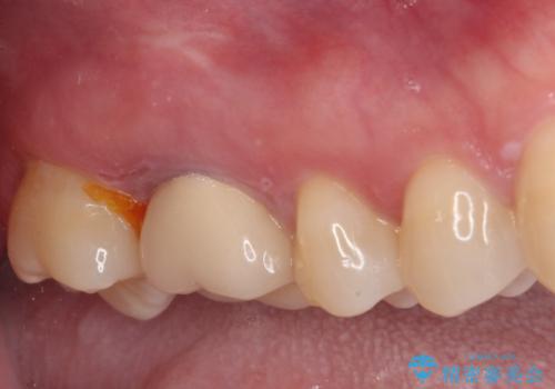 指摘された虫歯 オールセラミッククラウンによる補綴治療の治療前