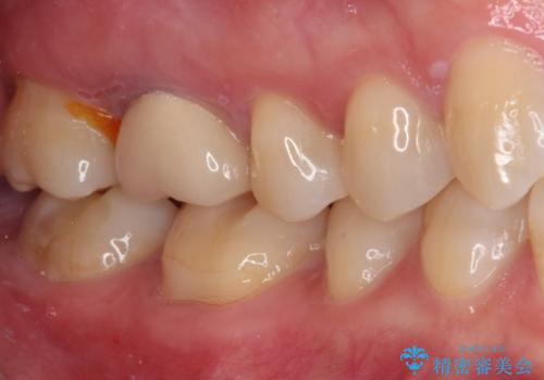 指摘された虫歯 オールセラミッククラウンによる補綴治療の治療前