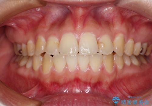 舌突出癖による開咬　舌のトレーニングを行いながら咬み合わせを改善の症例 治療後