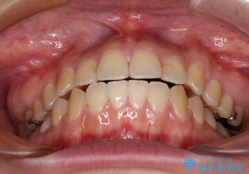 舌突出癖による開咬　舌のトレーニングを行いながら咬み合わせを改善の治療後