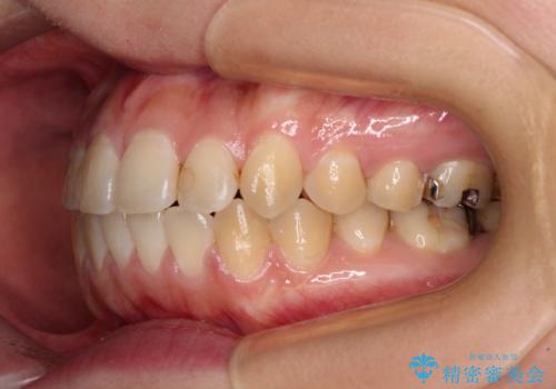 舌突出癖による開咬 舌のトレーニングを行いながら咬み合わせを改善の治療後