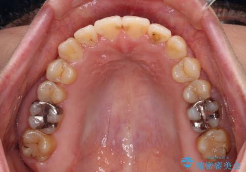 舌突出癖による開咬 舌のトレーニングを行いながら咬み合わせを改善の治療後