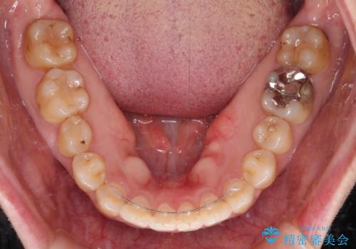 舌突出癖による開咬　舌のトレーニングを行いながら咬み合わせを改善の治療後