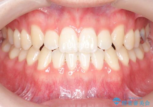 前歯で物を噛みきれない　マウスピース矯正で改善の症例 治療後