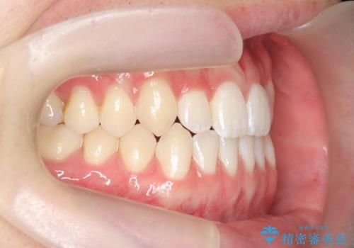 前歯で物を噛みきれない マウスピース矯正で改善の治療後
