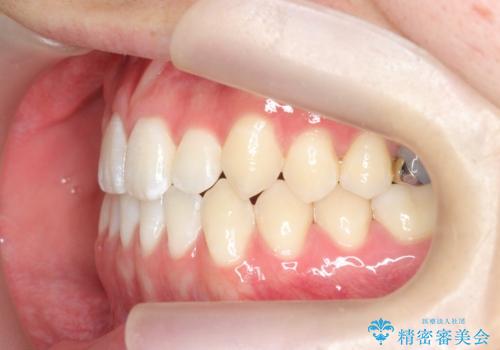 前歯で物を噛みきれない　マウスピース矯正で改善の治療後