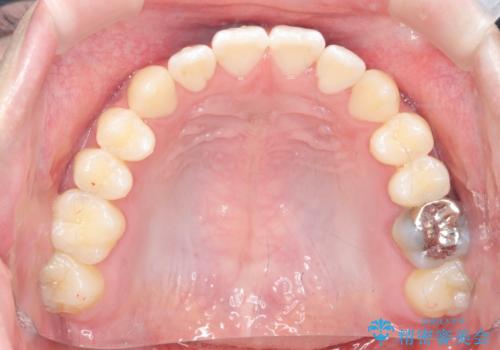 前歯で物を噛みきれない マウスピース矯正で改善の治療後