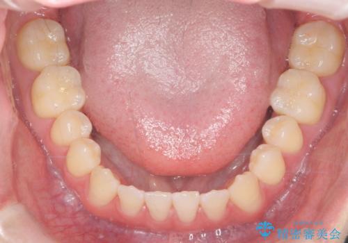 前歯で物を噛みきれない マウスピース矯正で改善の治療後
