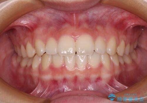 前歯のデコボコを治したい 高校生のインビザライン治療の治療中