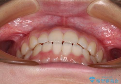 前歯のデコボコを治したい 高校生のインビザライン治療の治療中