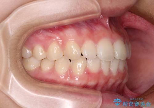 前歯のデコボコを治したい 高校生のインビザライン治療の治療中