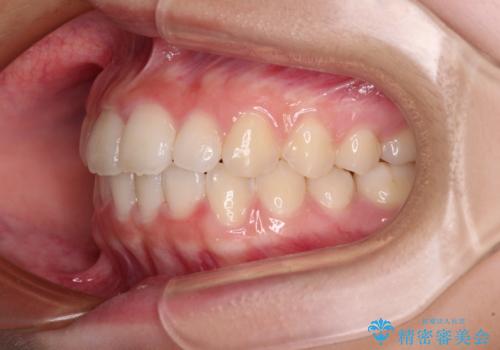 前歯のデコボコを治したい 高校生のインビザライン治療の治療中