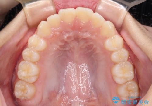 前歯のデコボコを治したい 高校生のインビザライン治療の治療中