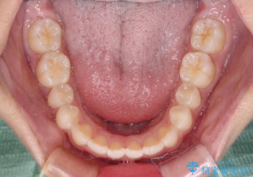 前歯のデコボコを治したい 高校生のインビザライン治療の治療中