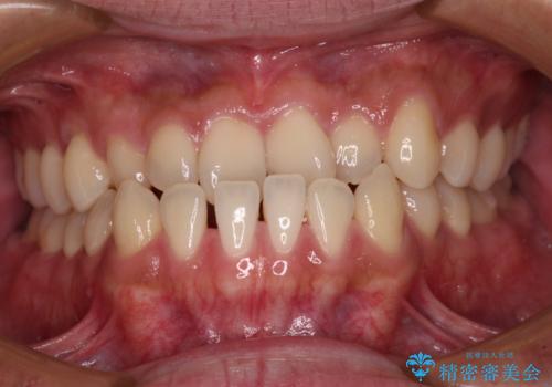 前歯のクロスバイトをワイヤー矯正で　結婚式までに治したいの症例 治療前