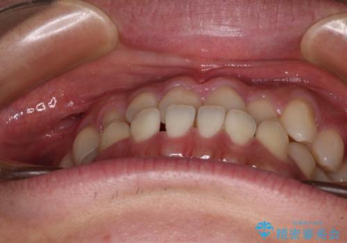 前歯のクロスバイトをワイヤー矯正で 結婚式までに治したいの治療前