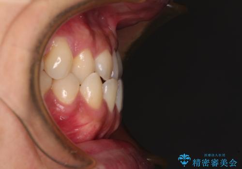 前歯のクロスバイトをワイヤー矯正で 結婚式までに治したいの治療前