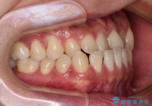 前歯のクロスバイトをワイヤー矯正で 結婚式までに治したいの治療前