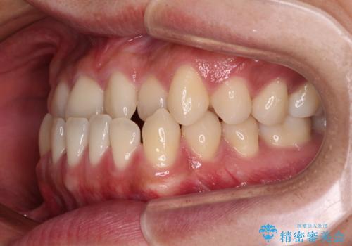 前歯のクロスバイトをワイヤー矯正で 結婚式までに治したいの治療前