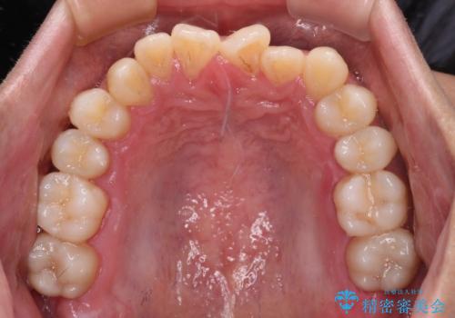 前歯のクロスバイトをワイヤー矯正で　結婚式までに治したいの治療前