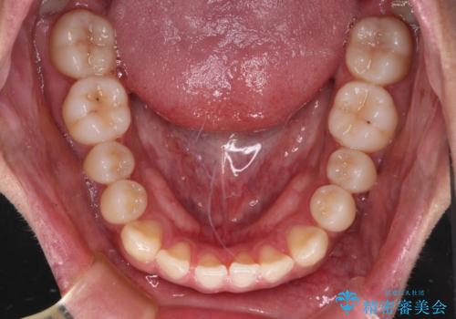 前歯のクロスバイトをワイヤー矯正で 結婚式までに治したいの治療前