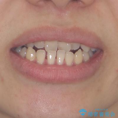 前歯のクロスバイトをワイヤー矯正で　結婚式までに治したいの治療前（顔貌）