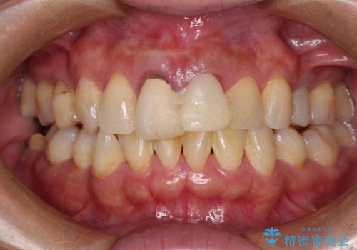 見栄えの悪い仮歯 前歯のオールセラミック治療の治療前
