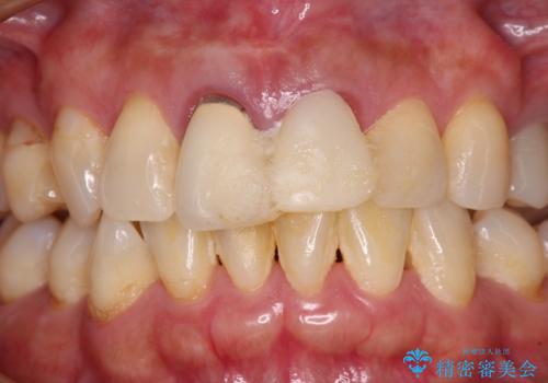 見栄えの悪い仮歯　前歯のオールセラミック治療の治療前