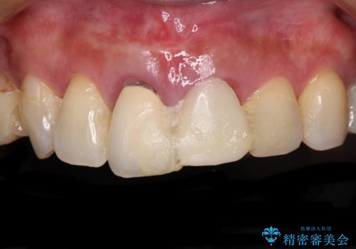 外科的歯内療法の症例 治療前