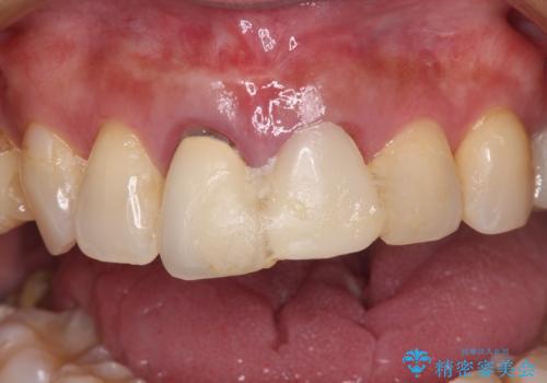 見栄えの悪い仮歯 前歯のオールセラミック治療の治療前