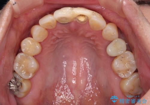 見栄えの悪い仮歯 前歯のオールセラミック治療の治療前