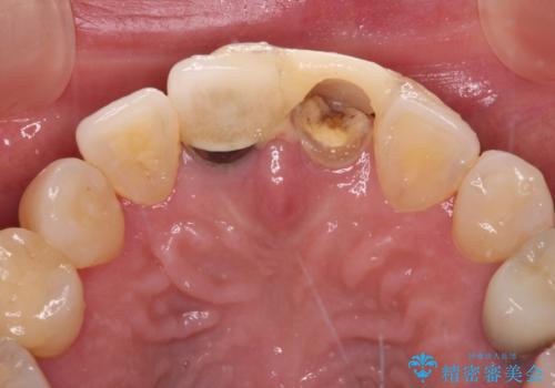 見栄えの悪い仮歯　前歯のオールセラミック治療の治療前