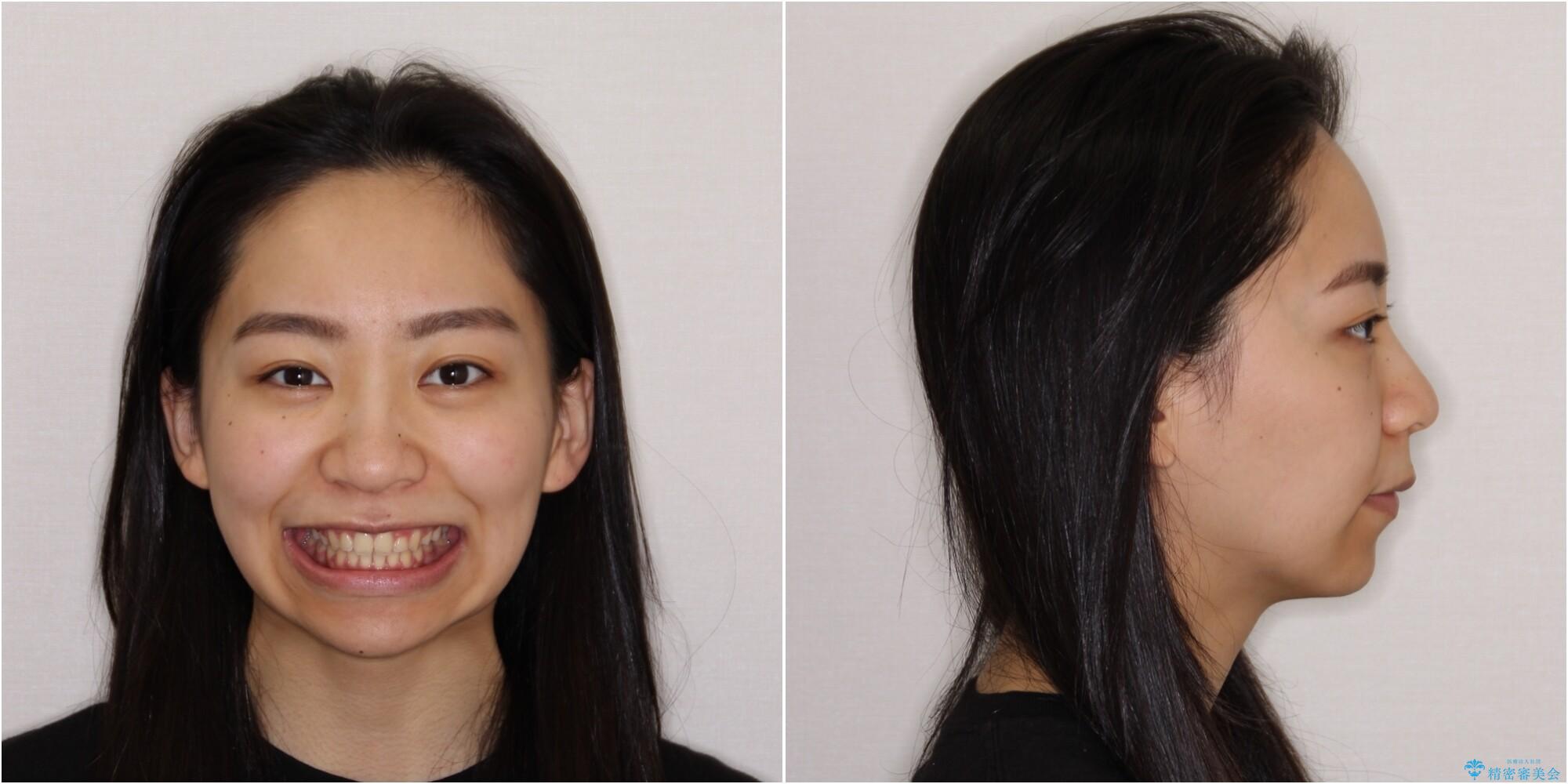 【モニター】閉じにくい口元 ワイヤー装置での抜歯矯正の治療後(顔貌)