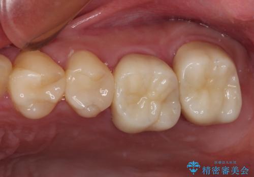 抜歯と言われた奥歯　根管治療と補綴治療